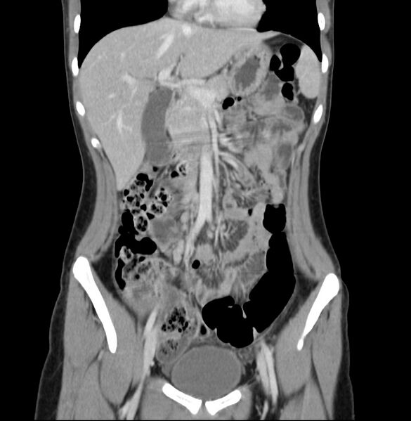 File:Appendicitis and incidental bicornuate uterus (Radiopaedia 22833-22853 D 14).jpg