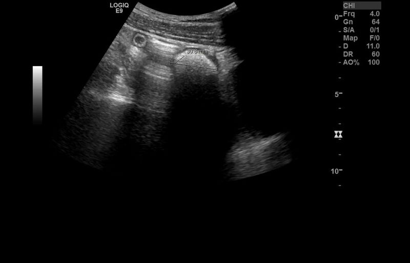 File:Appendicitis and incidental foregut duplication cyst (Radiopaedia 52962-58918 A 17).jpg