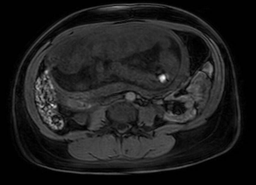 Appendicitis in gravida (MRI) (Radiopaedia 89433-106395 Axial DIXON 74).jpg