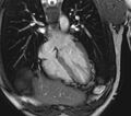 Arrhythmogenic right ventricular cardiomyopathy (Radiopaedia 39806-42237 D 109).jpg