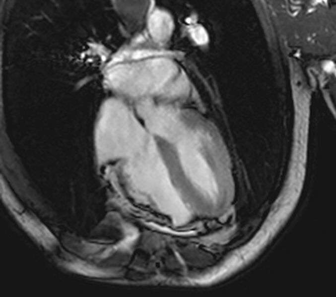 File:Arrhythmogenic right ventricular cardiomyopathy (Radiopaedia 39806-42237 D 17).jpg