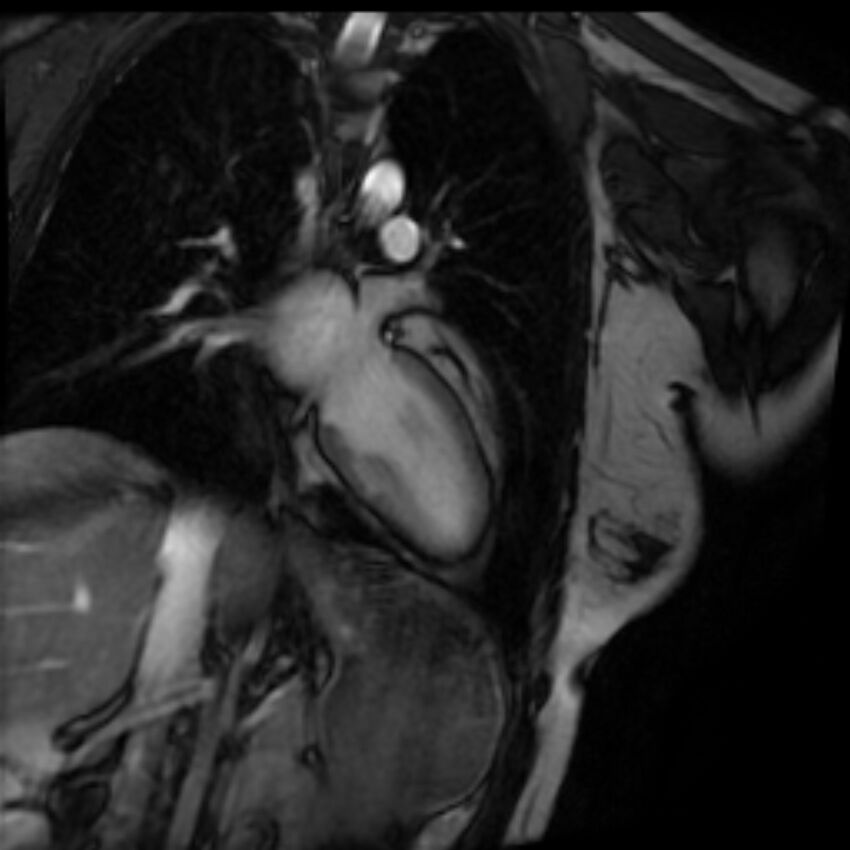 Arrhythmogenic right ventricular cardiomyopathy (Radiopaedia 87505-103850 2ch (LV) Cine SSFP 44).jpg