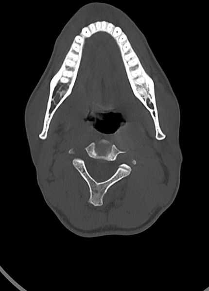 File:Arrow injury to the head (Radiopaedia 75266-86388 Axial bone window 23).jpg