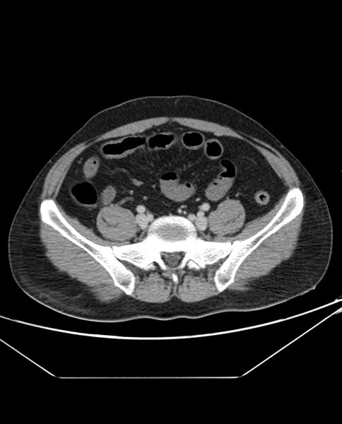 File:Arterial occlusive mesenteric ischemia (Radiopaedia 84641-100054 A 87).jpg