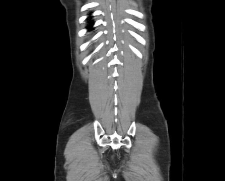 File:Arterial occlusive mesenteric ischemia (Radiopaedia 84641-100060 B 50).jpg