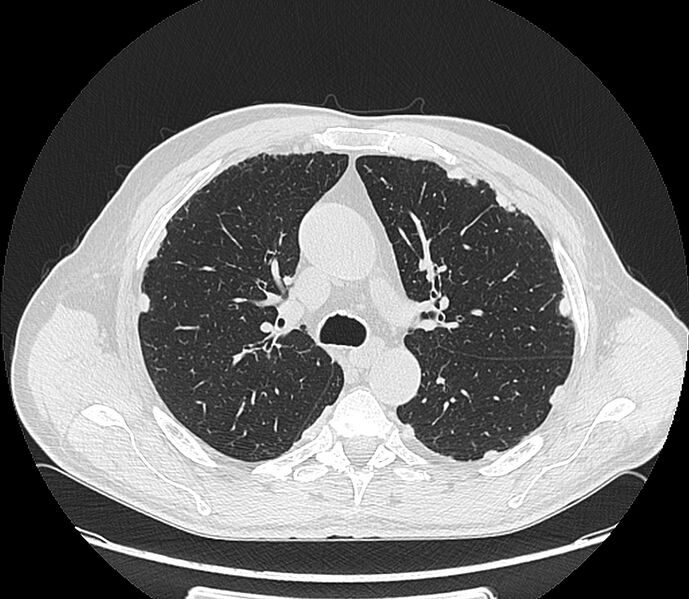 File:Asbestos pleural placques (Radiopaedia 57905-64872 Axial lung window 94).jpg