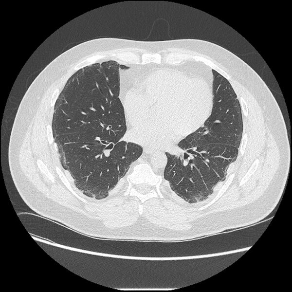 File:Asbestosis (Radiopaedia 45002-48961 Axial lung window 30).jpg