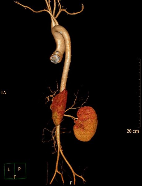 File:Ascending aortic pseudoaneurysm (Radiopaedia 28638-28910 D 21).jpg