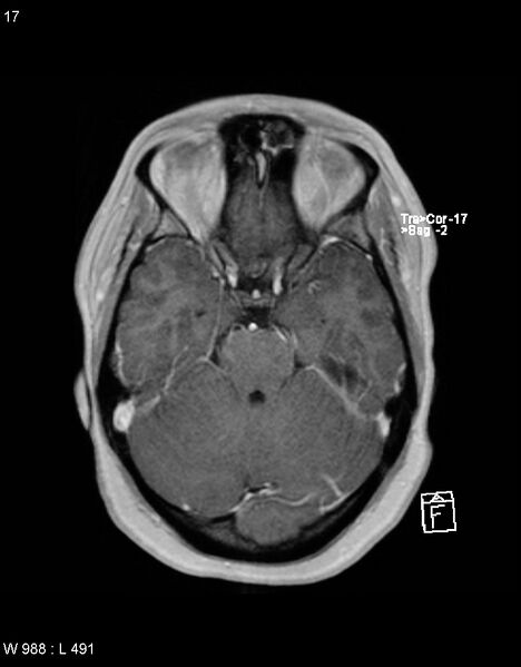 File:Astroblastoma (Radiopaedia 39792-42217 Axial T1 C+ 16).jpg