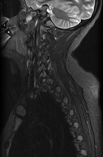 File:Astrocytoma - spinal cord (Radiopaedia 69769-79758 Sagittal STIR 11).jpg