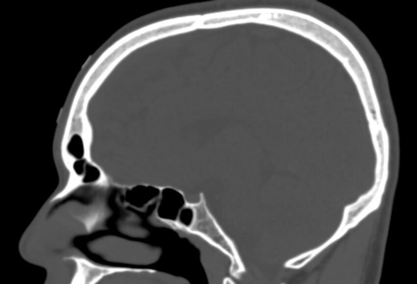 Asymptomatic occipital spur (Radiopaedia 87753-104201 Sagittal bone window 141).jpg