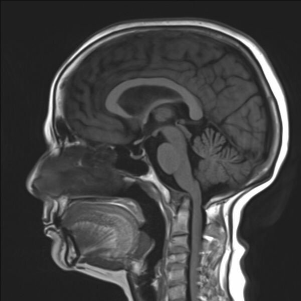 File:Atlanto-occipital assimilation with basilar invagination (Radiopaedia 70122-80157 Sagittal T1 12).jpg