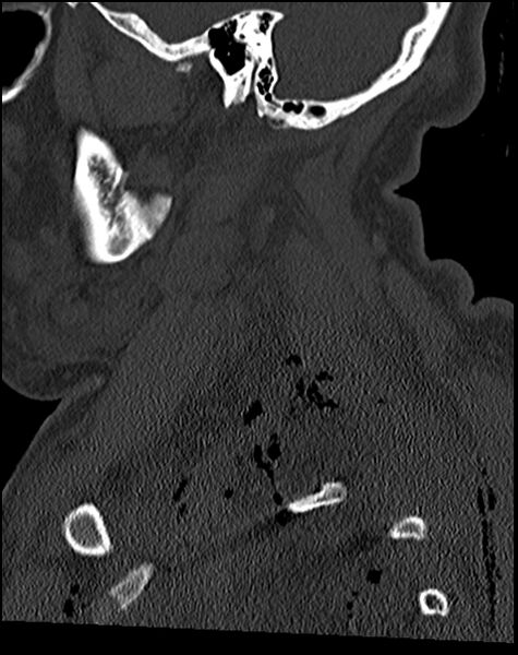 File:Atlanto-occipital dissociation - Traynelis type 1 (Radiopaedia 87570-103948 Sagittal bone window 24).jpg