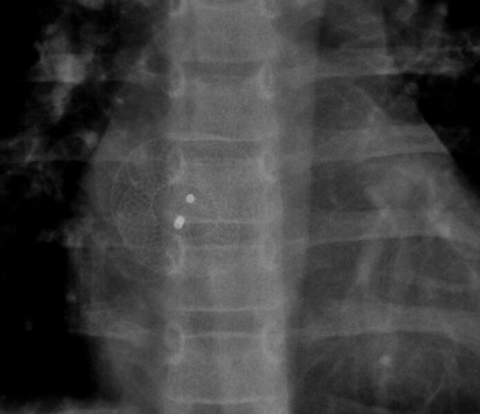 File:Atrial septal defect closure device (Radiopaedia 9338-10024 Frontal 1).jpg