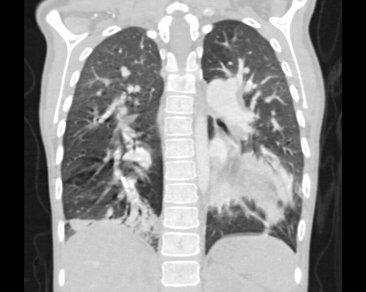 File:Atrial septal defect complicated by Eisenmenger syndrome (Radiopaedia 53707-59768 Sagittal lung window 17).jpg