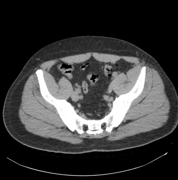 File:Atrophic kidney due to severe chronic obstructive hydronephrosis (Radiopaedia 40828-43474 Axial non-contrast 36).jpg