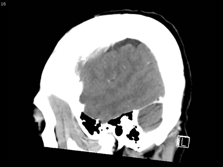 Atypical meningioma - intraosseous (Radiopaedia 64915-73867 F 15).jpg