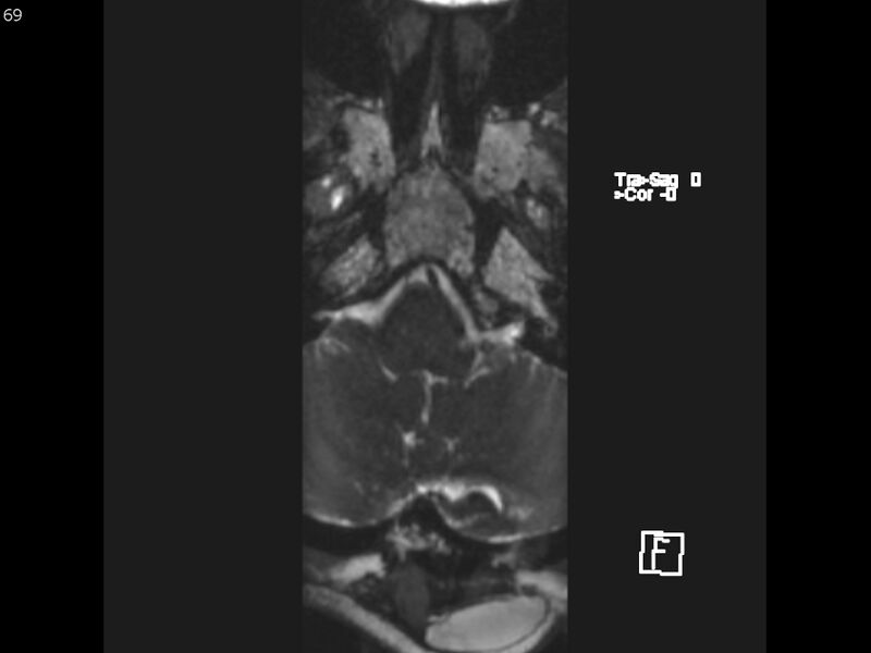File:Atypical meningioma - intraosseous (Radiopaedia 64915-74572 Axial CISS 69).jpg