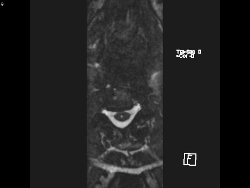 File:Atypical meningioma - intraosseous (Radiopaedia 64915-74572 Axial CISS 9).jpg