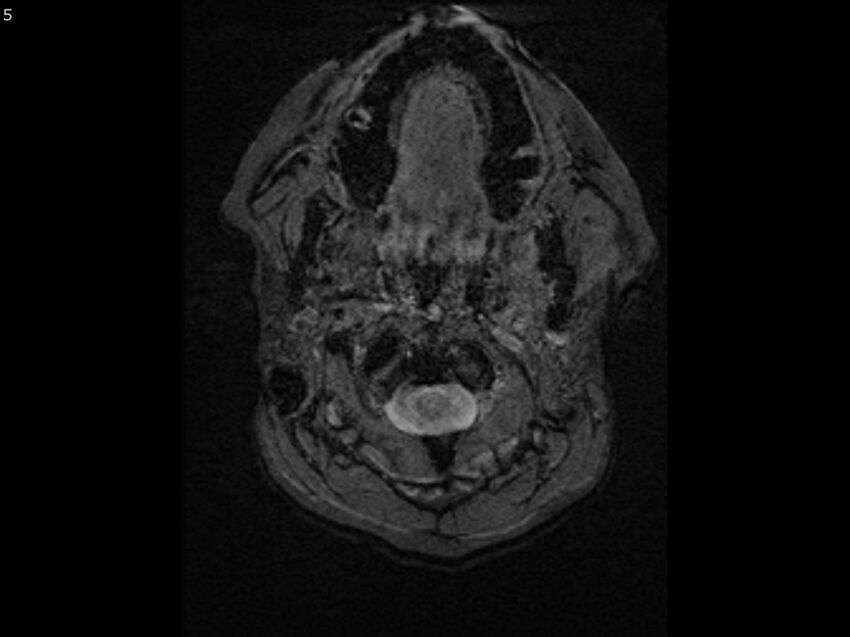 Atypical meningioma - intraosseous (Radiopaedia 64915-74572 Axial SWI 5).jpg