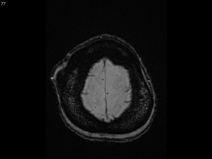 Atypical meningioma - intraosseous (Radiopaedia 64915-74572 Axial SWI 77).jpg