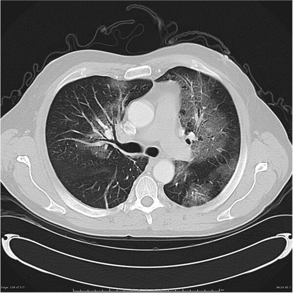 File:Atypical pneumonia - Q fever (Radiopaedia 21993-21989 lung window 17).jpg