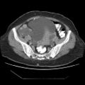 Atypical retroperitoneal lymphocoeles with large leiomyoma of uterus (Radiopaedia 32084-33024 A 29).jpg