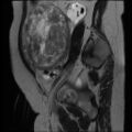 Atypical retroperitoneal lymphocoeles with large leiomyoma of uterus (Radiopaedia 32084-33027 Sagittal T2 7).jpg