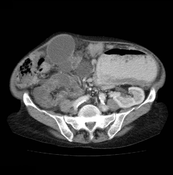 File:Autosomal dominant polycystic kidney disease (Radiopaedia 16777-16490 A 40).jpg