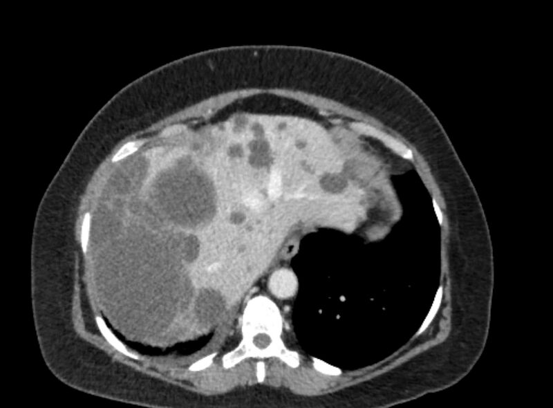 File:Autosomal dominant polycystic kidney disease (Radiopaedia 57124-64017 A 23).jpg