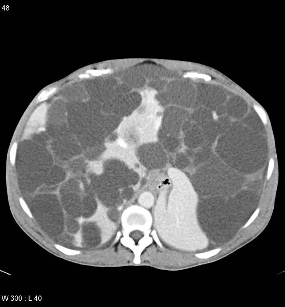 File:Autosomal dominant polycystic kidney disease with extensive hepatic involvement (Radiopaedia 5204-6971 B 4).jpg