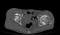 Avascular necrosis of the left hip (Radiopaedia 75068-86125 Axial bone window 39).jpg