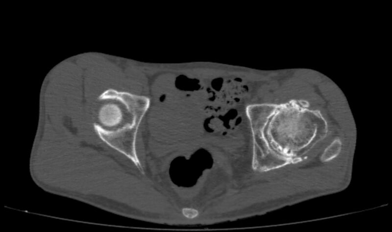 File:Avascular necrosis of the left hip (Radiopaedia 75068-86125 Axial bone window 39).jpg