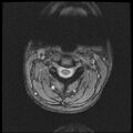 Axis fracture - MRI (Radiopaedia 71925-82375 Axial T2 fat sat 6).jpg