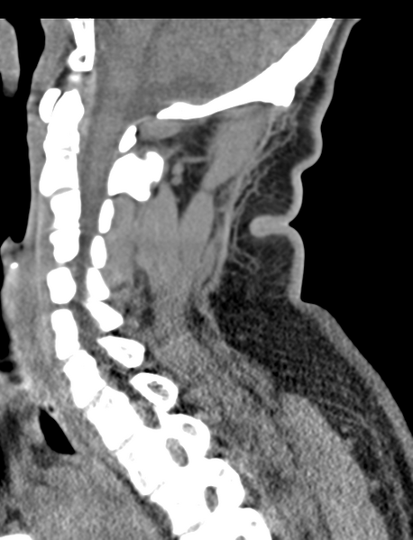 File:Axis peg fracture (type 3) and atlas lateral mass (type 4) fracture (Radiopaedia 37474-39324 D 34).png