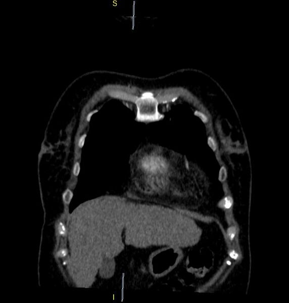 File:Azygos vein aneurysm (Radiopaedia 77824-90130 C 5).JPG