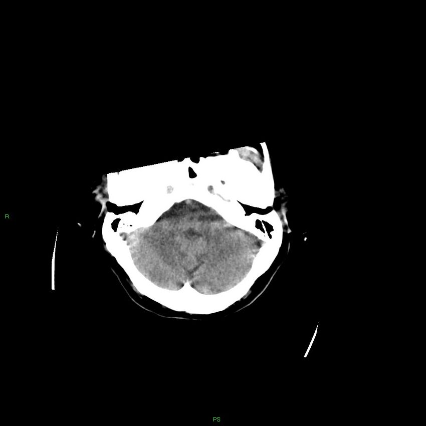 Basal ganglia hemorrhage (Radiopaedia 58349-65472 Axial non-contrast 46).jpg