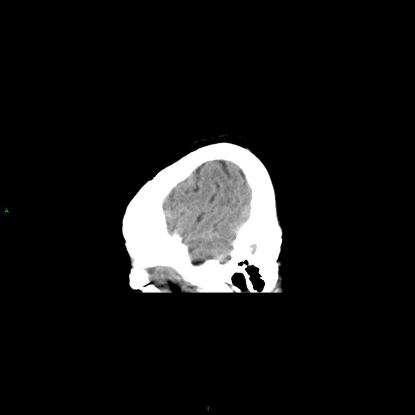Basal ganglia hemorrhage (Radiopaedia 58349-65472 C 6).jpg