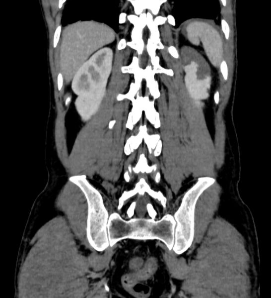 File:Behçet's disease- abdominal vasculitis (Radiopaedia 55955-62570 B 50).jpg