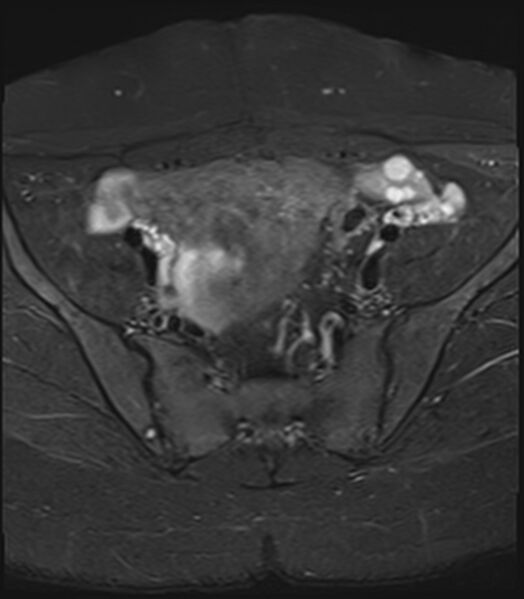 File:Bicornuate, unicollis uterus (Radiopaedia 79468-92593 Axial STIR 3).jpg