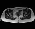 Bicornuate bicollis uterus (Radiopaedia 61626-69616 Axial T2 27).jpg