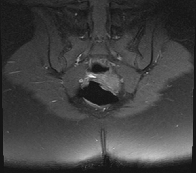 File:Bicornuate uterus (Radiopaedia 71214-81511 Coronal T1 fat sat 3).jpg