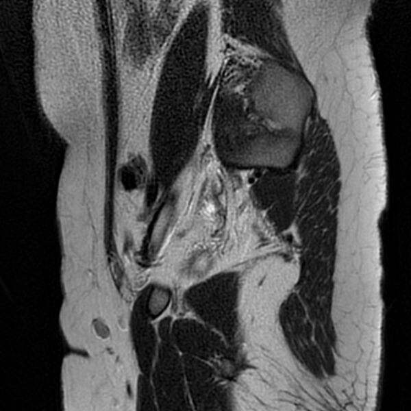 File:Bicornuate uterus (Radiopaedia 72135-82643 Sagittal T2 18).jpg