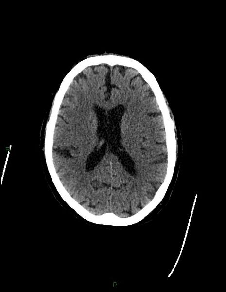 File:Bilateral acute middle cerebral artery territory infarcts (Radiopaedia 77319-89401 Axial non-contrast 52).jpg