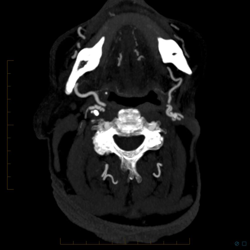 Bilateral chronic common carotid occlusion (Radiopaedia 50849-56362 D 36).jpg