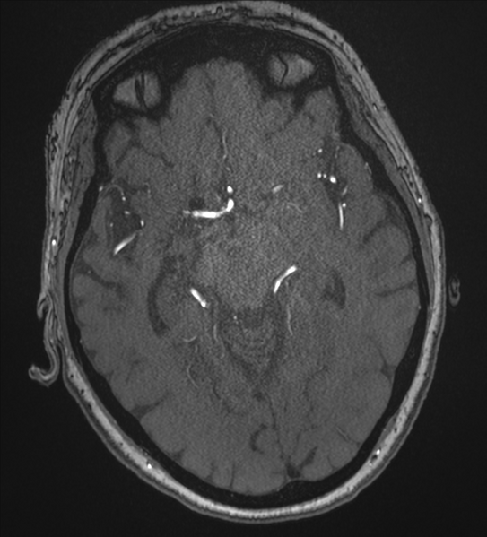 File:Bilateral fetal posterior communicating arteries (Radiopaedia 41286-44102 Axial MRA 92).png