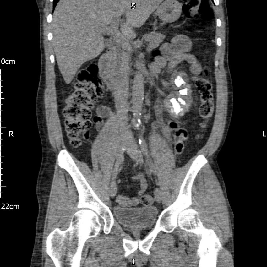Bilateral medullary nephrocalcinosis with ureteric calculi (Radiopaedia 71269-81569 Coronal non-contrast 33).jpg