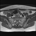 Bilateral ovarian endometriomas (Radiopaedia 87085-103347 Axial T1 3).jpg