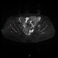 Bilateral ovarian fibroma (Radiopaedia 44568-48293 Axial STIR 12).jpg