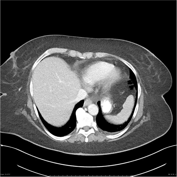 File:Bilateral psoas hematomas (Radiopaedia 24057-24279 A 10).jpg